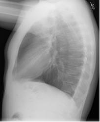 Боковая рентгенограмма легких в норме